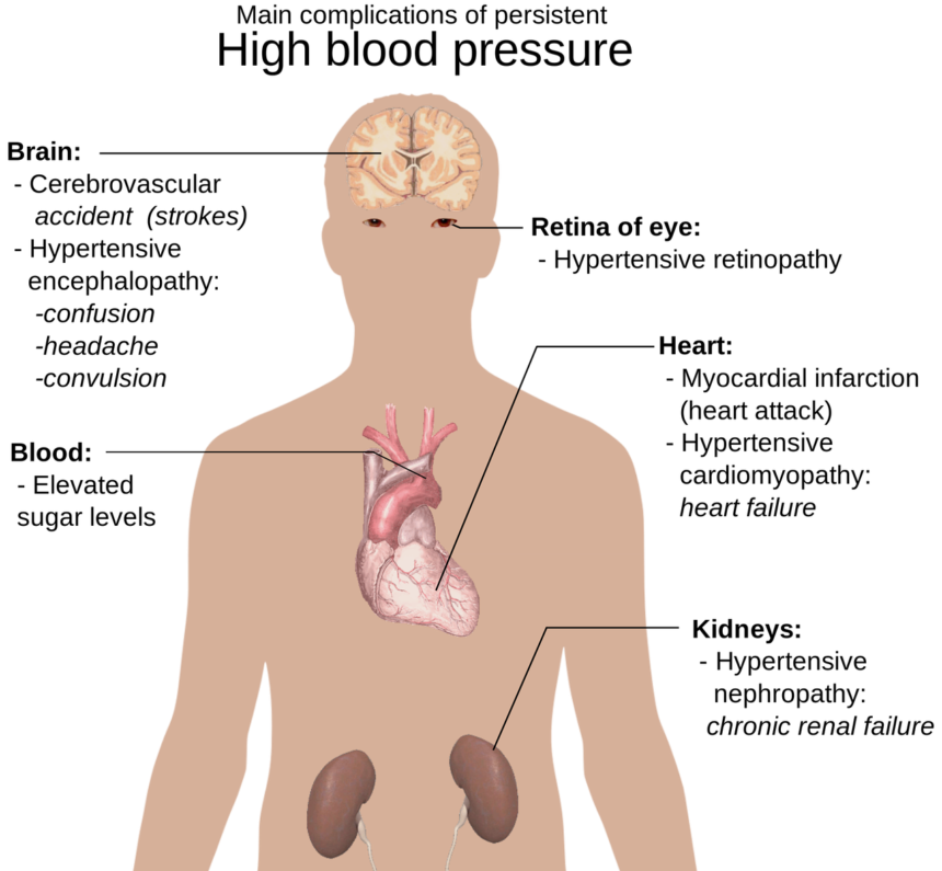 Diagram of the upper human body showing possible complications of high blood pressure.